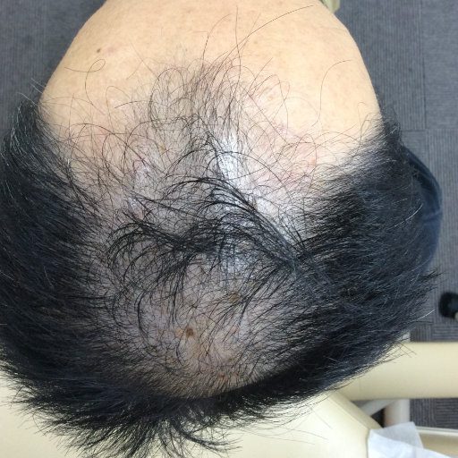 40代の男性、発毛の前で髪が少ない