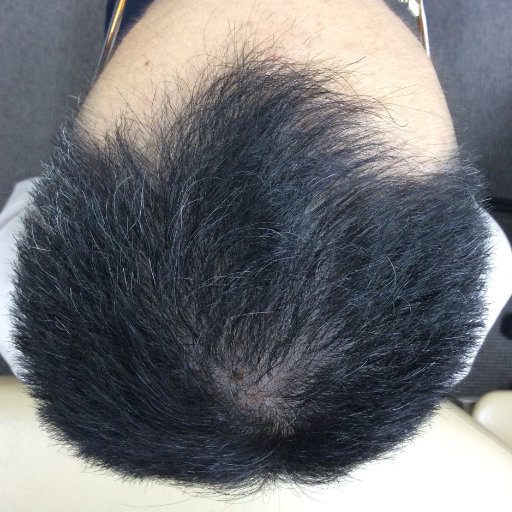 40代の男性、１２ヶ月で髪が増えた写真
