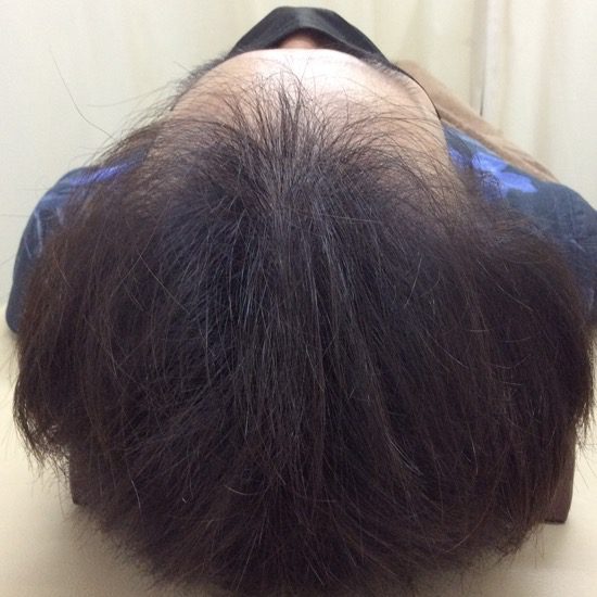３０代男性　発毛１２ヶ月